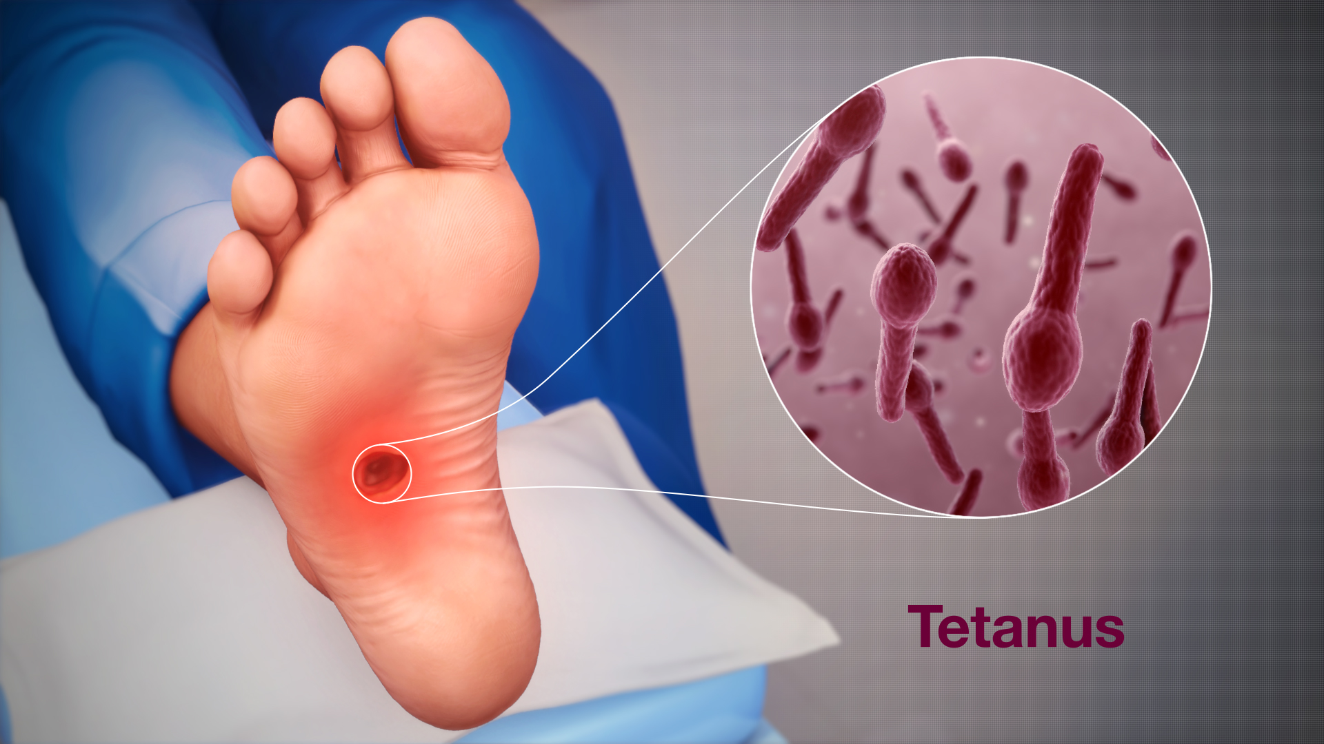 Tetanus: symptomer, årsaker og behandling