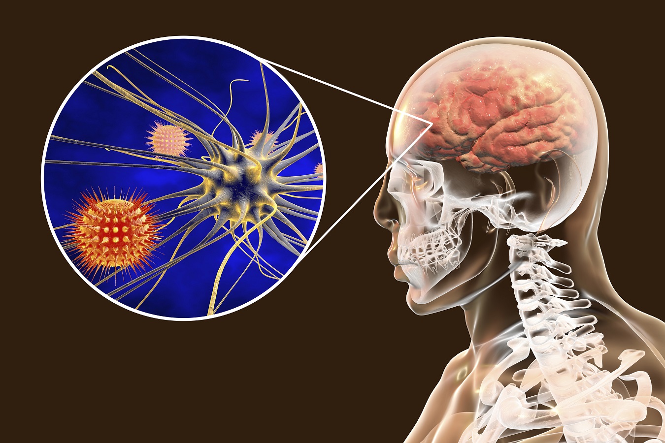 Bakteriell hjernehinnebetennelse: symptomer og behandling