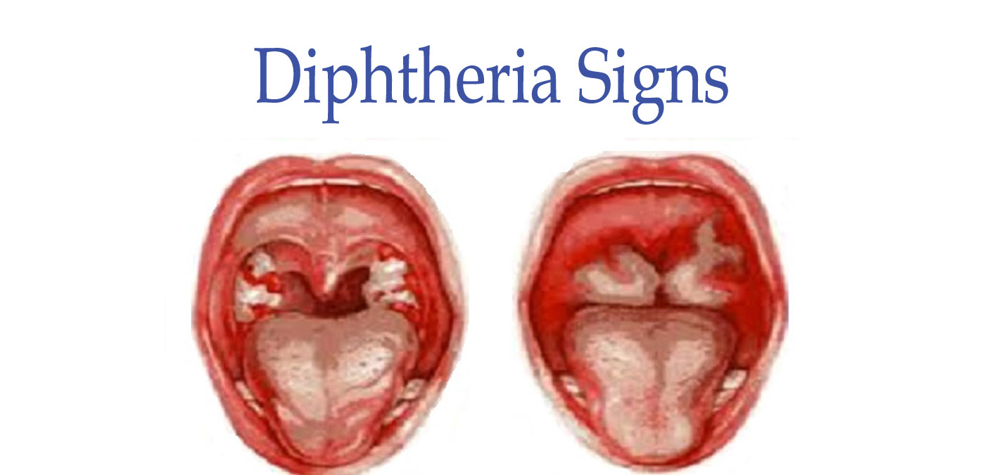 Difteri: årsaker, symptomer og behandling