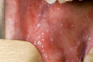 Bilde av meslinger i munnen