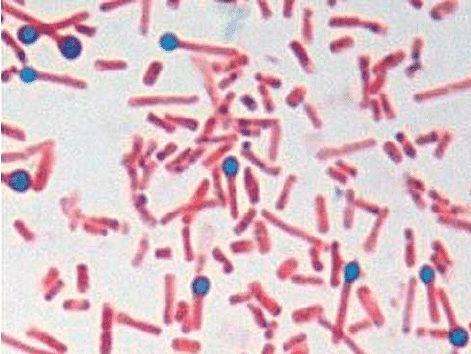 en.  Sporer og bakterier av Clostridium tetani med en typisk trommelstangform isolert fra skorpen av avhornsårene i tilfelle 1 (gramfarging-1000x). 