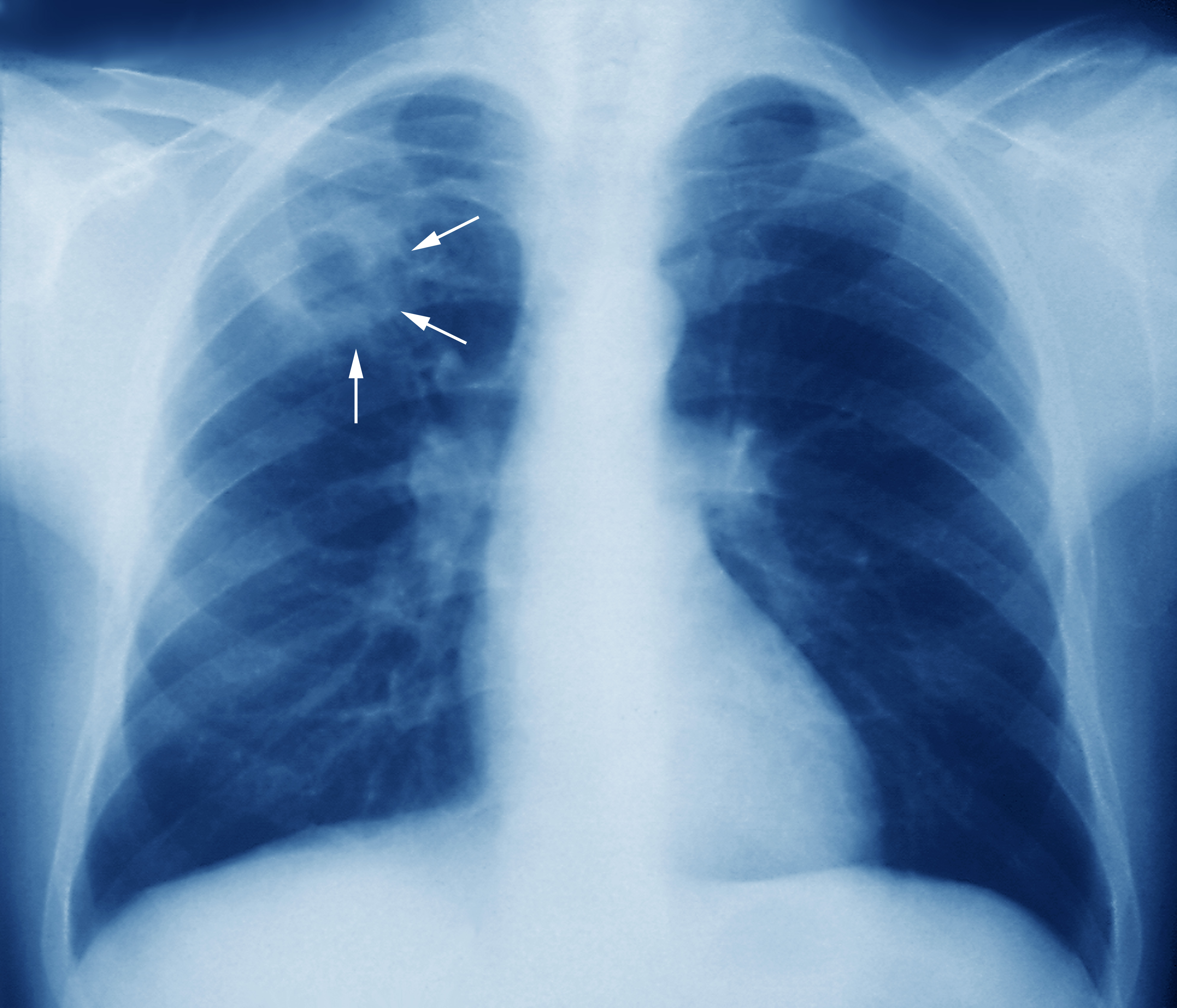 http://mednorge.com/wp-content/uploads/2020/12/m2700245-tuberculosis-chest-x-ray-science-photo-library-high.jpg
