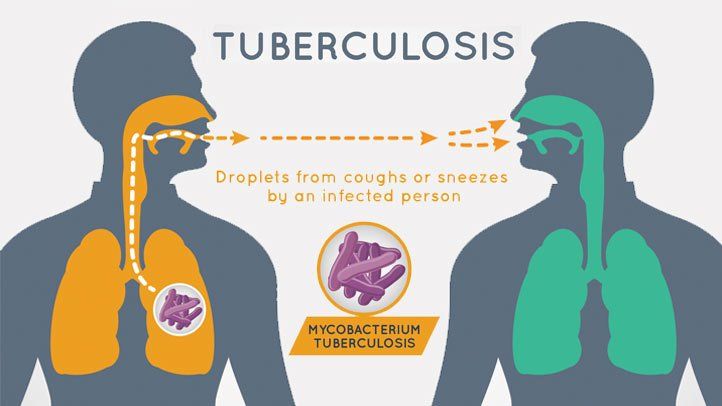 Tuberkulose: årsaker, symptomer og behandling