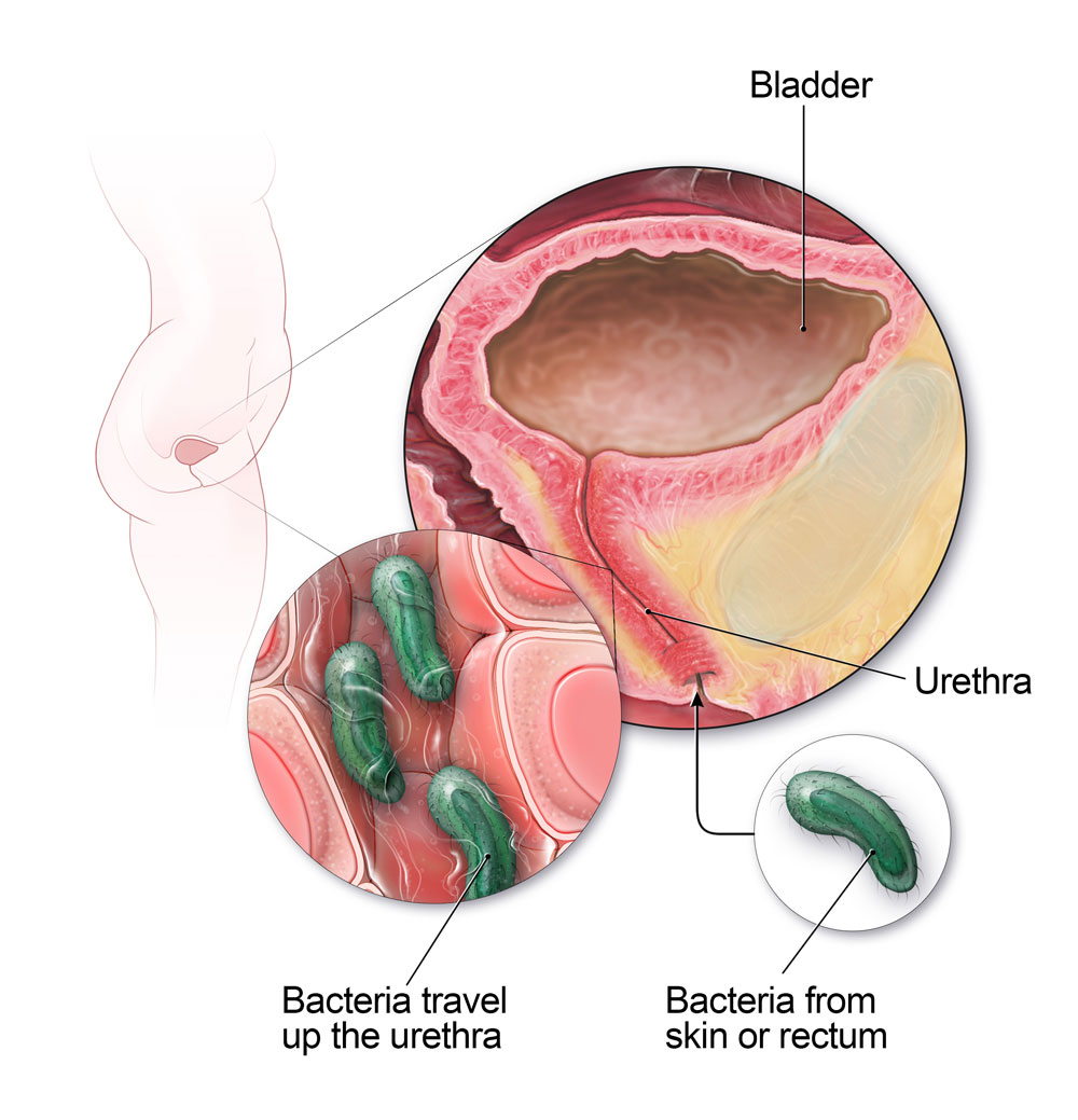 Hos kvinner kan bakterier fra huden eller endetarmen reise opp urinrøret og forårsake blæreinfeksjon.