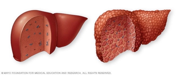 Normal lever- og levercirrhose