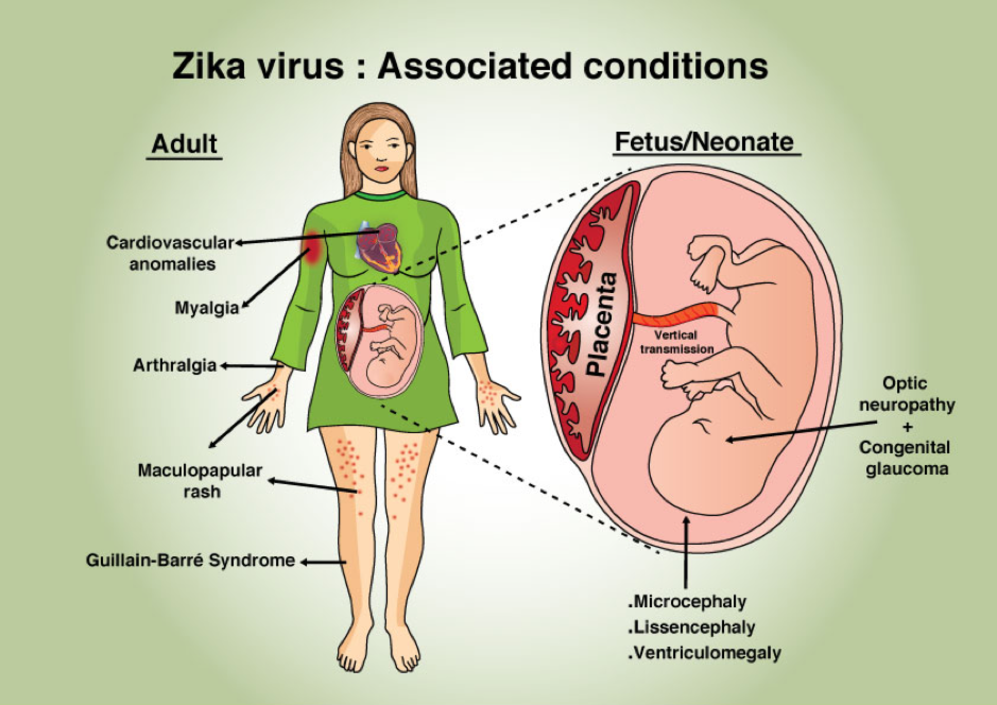 Komplikasjoner fra Zika-virusinfeksjon