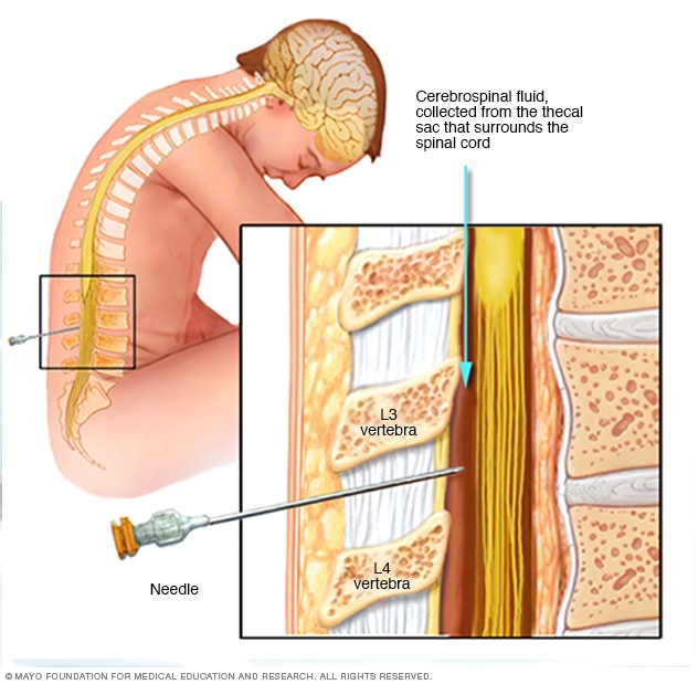 En nål fjerner væske fra området rundt ryggmargen